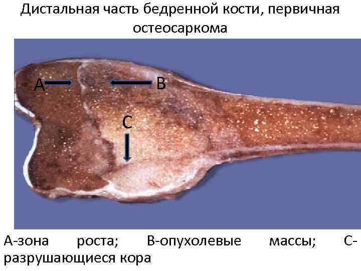 Дистальная часть бедренной кости, первичная остеосаркома В А С А-зона роста; В-опухолевые разрушающиеся кора