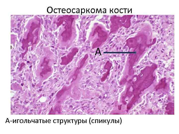 Остеосаркома кости А А-игольчатые структуры (спикулы) 