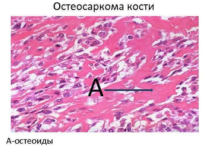 Остеосаркома кости А А-остеоиды 