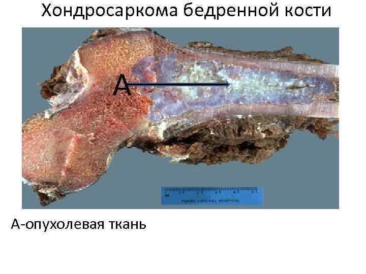 Хондросаркома бедренной кости А А-опухолевая ткань 
