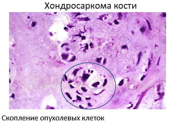 Хондросаркома кости Скопление опухолевых клеток 