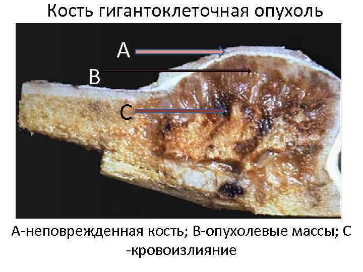 Кость гигантоклеточная опухоль В А С А-неповрежденная кость; В-опухолевые массы; С -кровоизлияние 