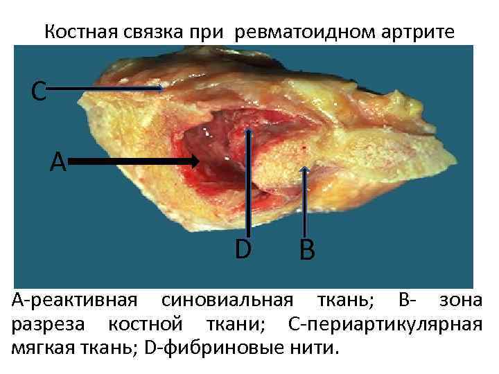 Костная связка при ревматоидном артрите С А D В А-реактивная синовиальная ткань; В- зона
