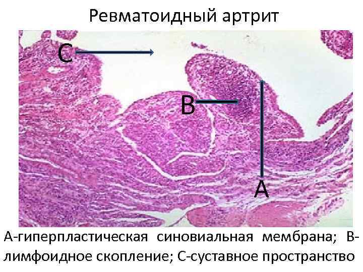 Ревматоидный артрит С В А А-гиперпластическая синовиальная мембрана; Влимфоидное скопление; С-суставное пространство 