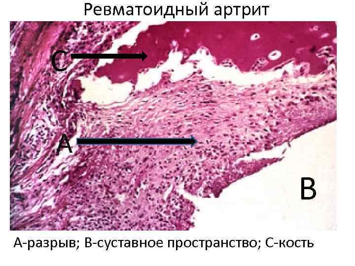 Ревматоидный артрит С А В А-разрыв; В-суставное пространство; С-кость 