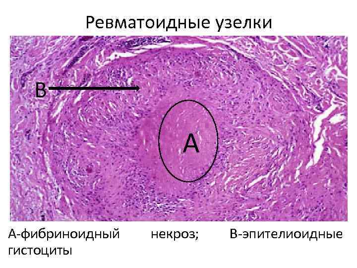 Ревматоидные узелки В А А-фибриноидный гистоциты некроз; В-эпителиоидные 