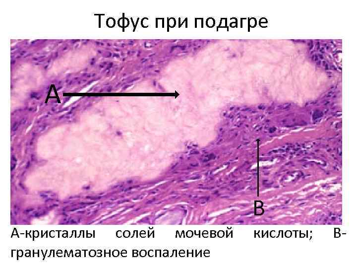 Тофус при подагре А В А-кристаллы солей мочевой гранулематозное воспаление кислоты; В- 