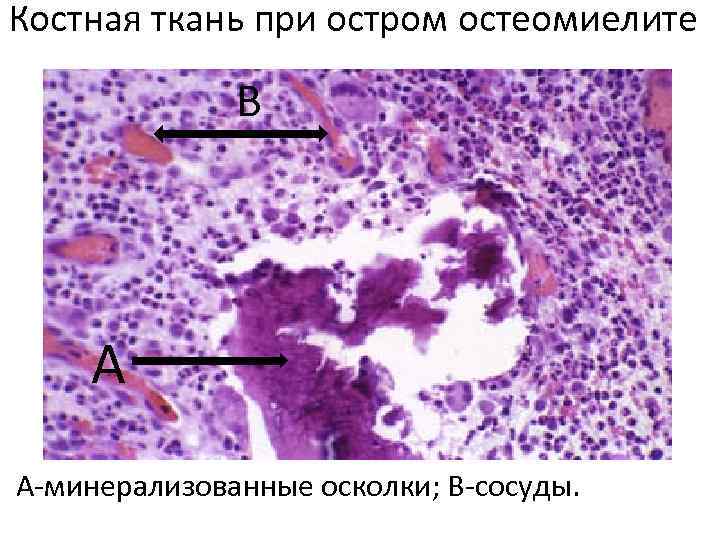 Костная ткань при остром остеомиелите В А А-минерализованные осколки; В-сосуды. 