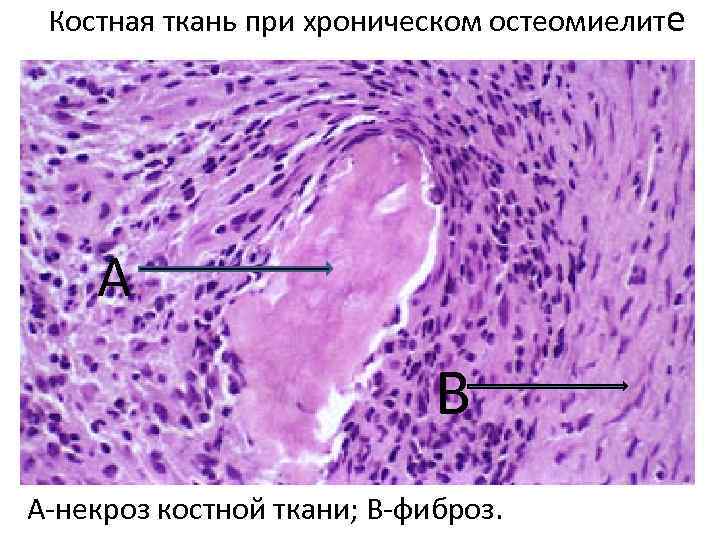 Костная ткань при хроническом остеомиелите А В А-некроз костной ткани; В-фиброз. 
