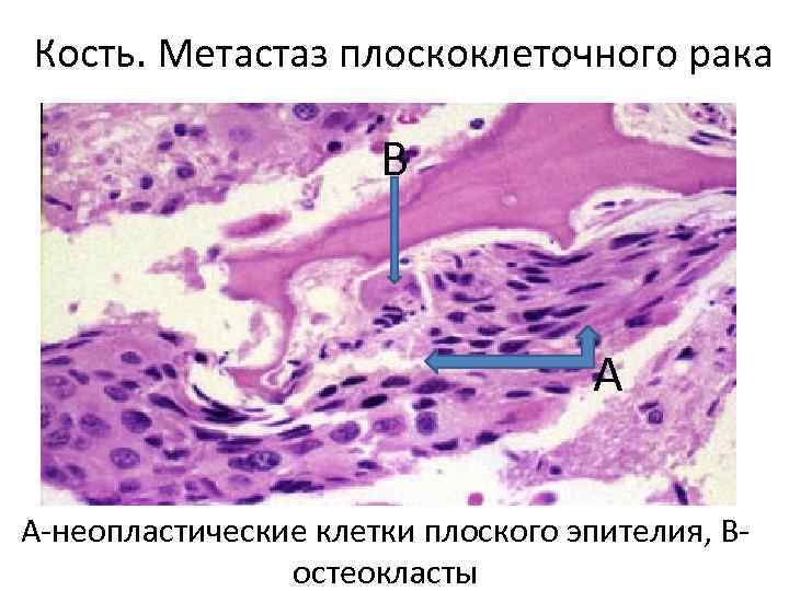 Кость. Метастаз плоскоклеточного рака В А А-неопластические клетки плоского эпителия, Востеокласты 