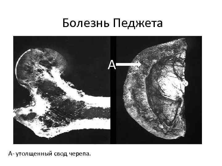 Болезнь Педжета А А- утолщенный свод черепа. 