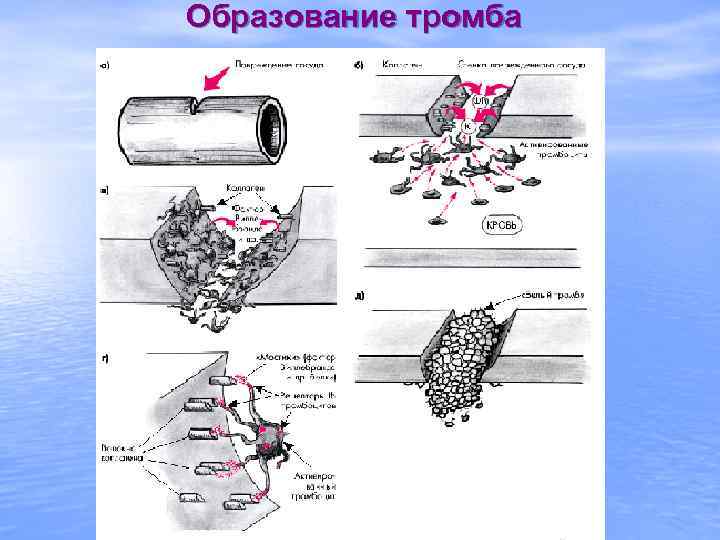 Образование тромба 