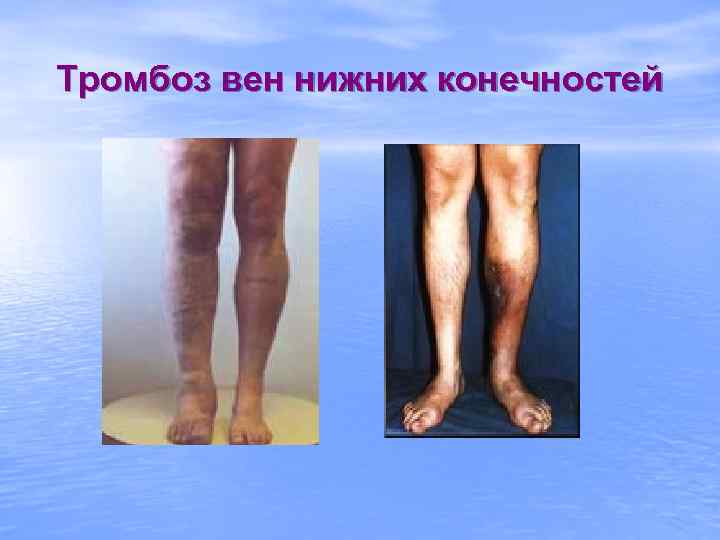 Тромбоз вен нижних конечностей 