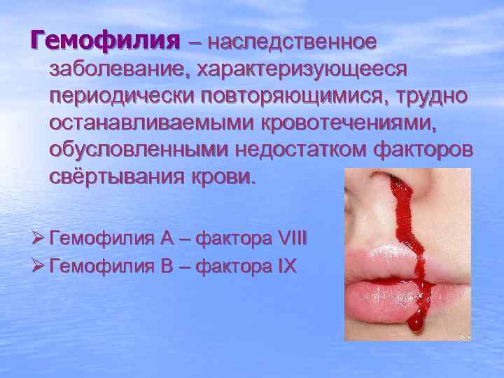 Гемофилия – наследственное заболевание, характеризующееся периодически повторяющимися, трудно останавливаемыми кровотечениями, обусловленными недостатком факторов свёртывания