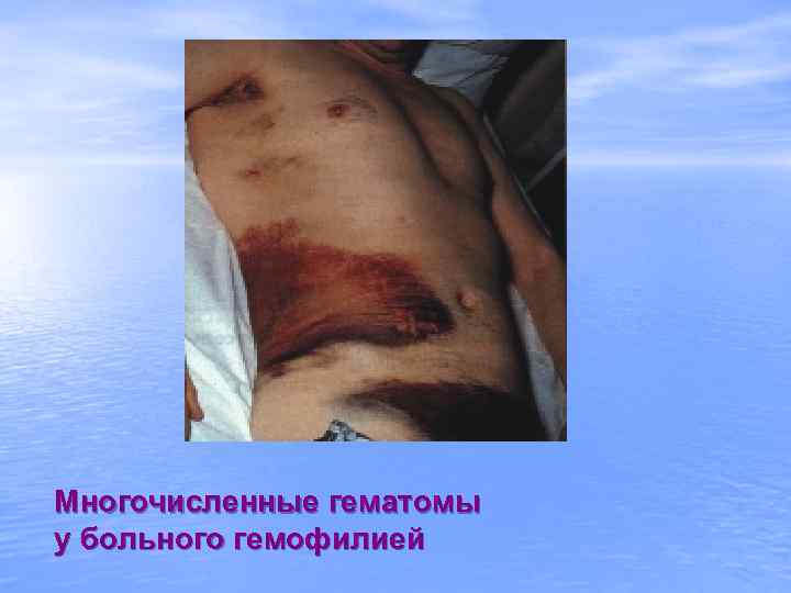 Многочисленные гематомы у больного гемофилией 