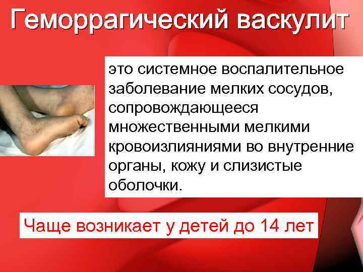 Геморрагический васкулит это системное воспалительное заболевание мелких сосудов, сопровождающееся множественными мелкими кровоизлияниями во внутренние