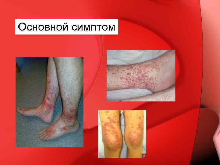 Основной симптом 