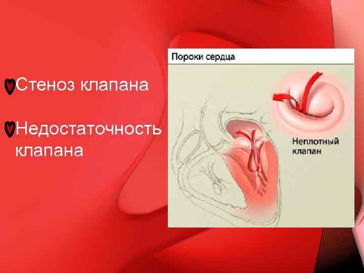 Стеноз клапана Недостаточность клапана 