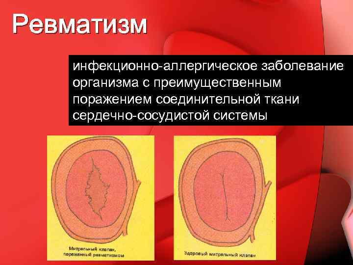 Ревматизм инфекционно-аллергическое заболевание организма с преимущественным поражением соединительной ткани сердечно-сосудистой системы 