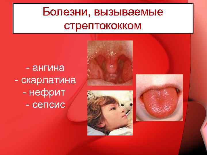 Болезни, вызываемые стрептококком - ангина - скарлатина - нефрит - сепсис 