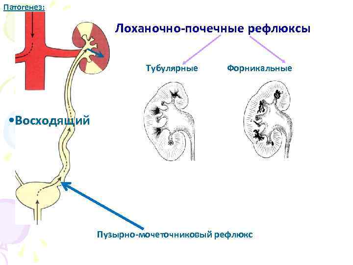 Рефлюкс нефропатия презентация