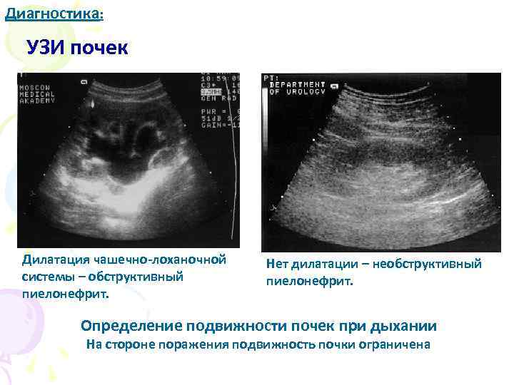 Лоханка на узи у ребенка. Чашечно лоханочная система на УЗИ. Измерение почек на УЗИ схема. Чашечно-лоханочная система УЗИ норма. Расширение ЧЛС почек.