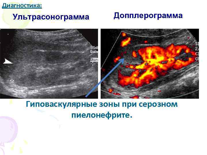 Диагностика: Ультрасонограмма Допплерограмма Гиповаскулярные зоны при серозном пиелонефрите. 