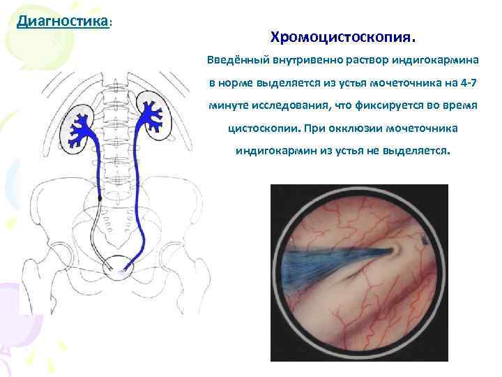 Диагностика: Хромоцистоскопия. Введённый внутривенно раствор индигокармина в норме выделяется из устья мочеточника на 4