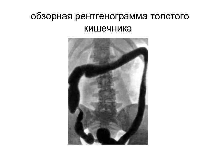 обзорная рентгенограмма толстого кишечника 