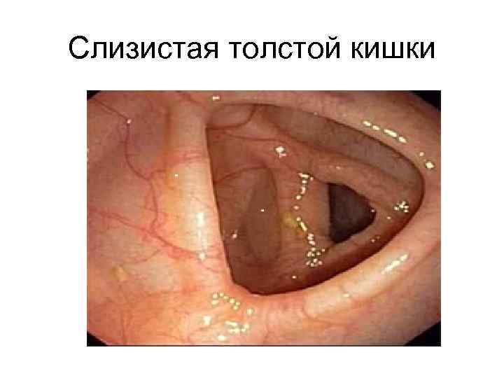 Слизистая толстой кишки 