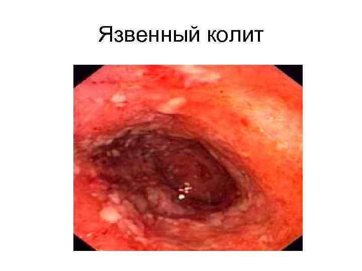 Язвенный колит 