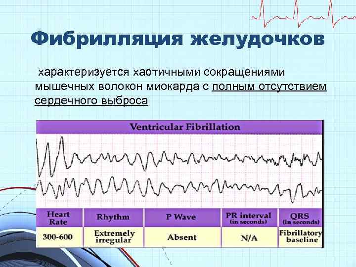 Фибрилляция желудочков характеризуется хаотичными сокращениями мышечных волокон миокарда с полным отсутствием сердечного выброса 