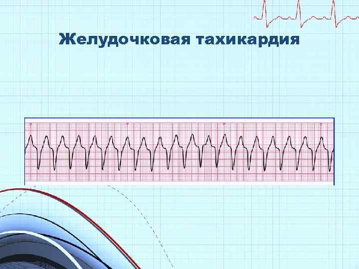 Желудочковая тахикардия 