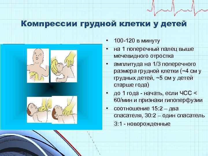 Компрессии грудной клетки у детей • 100 -120 в минуту • на 1 поперечный