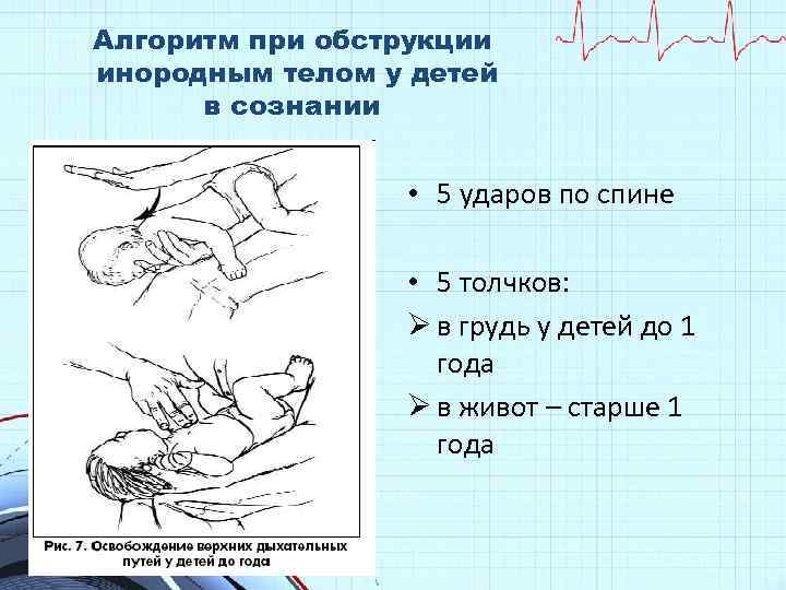Алгоритм при обструкции инородным телом у детей в сознании • 5 ударов по спине