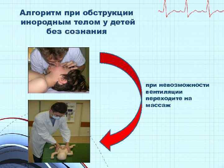 Алгоритм при обструкции инородным телом у детей без сознания при невозможности вентиляции переходите на