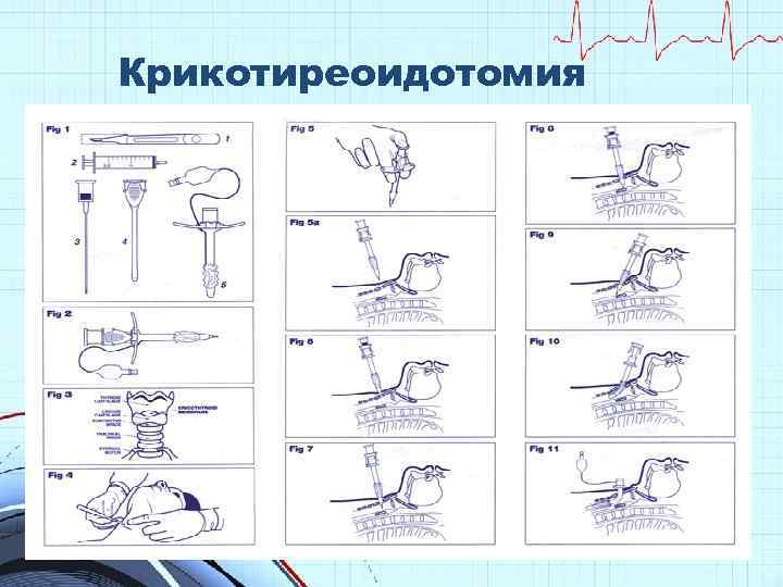 Крикотиреоидотомия 