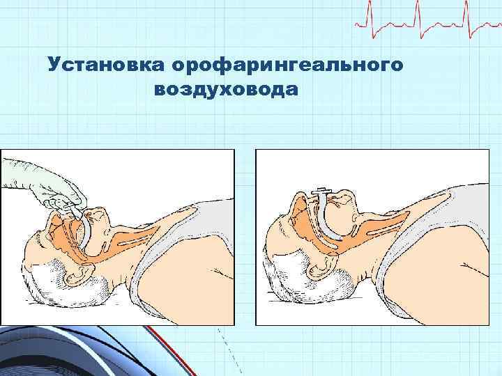 Установка орофарингеального воздуховода 