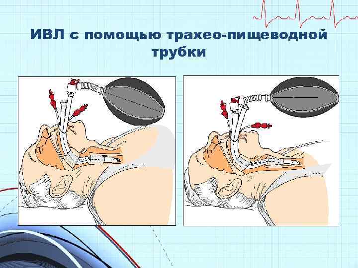 ИВЛ с помощью трахео-пищеводной трубки 