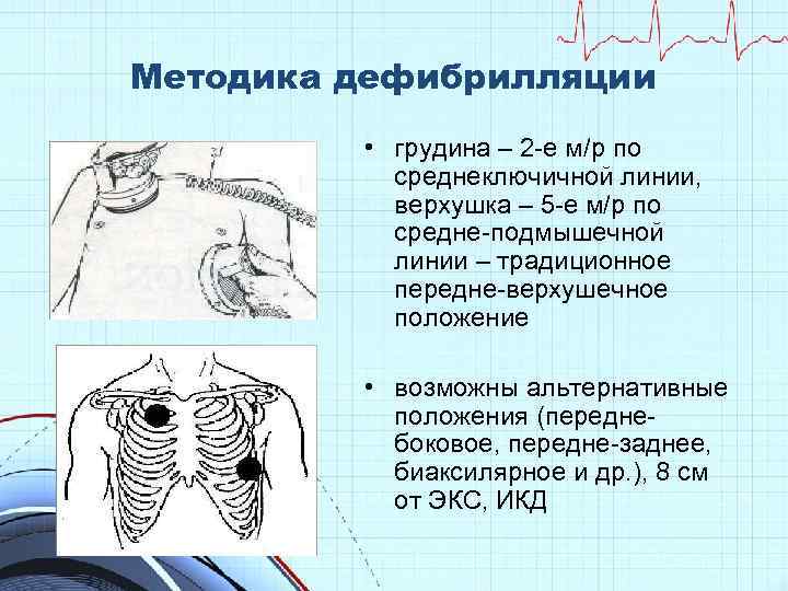 Методика дефибрилляции • грудина – 2 -е м/р по среднеключичной линии, верхушка – 5