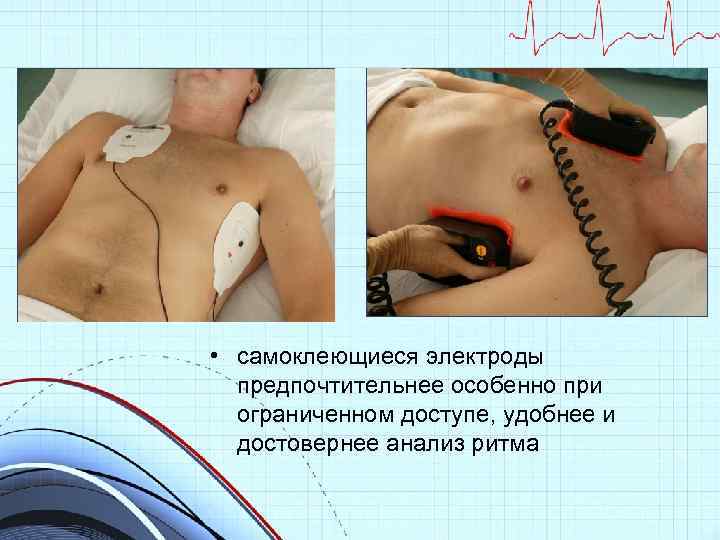  • самоклеющиеся электроды предпочтительнее особенно при ограниченном доступе, удобнее и достовернее анализ ритма