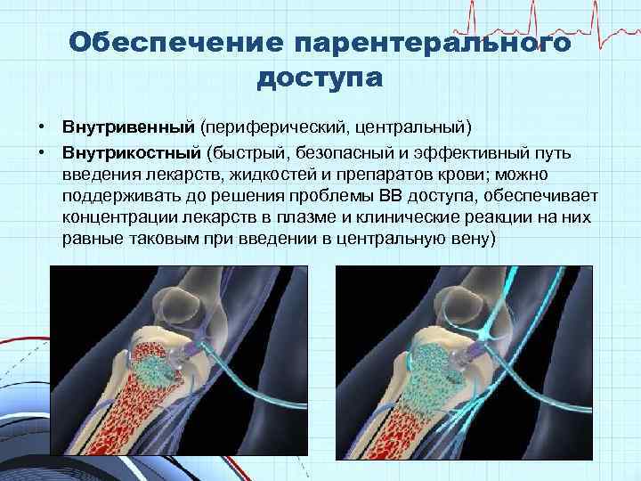 Проблемы с доступом. Внутрикостное Введение. Внутрикостное Введение препаратов. Внутрикостный путь введения лекарственных средств. Внутрикистозный путь введения.