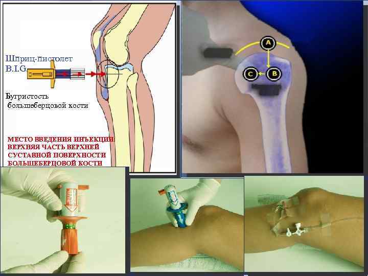 Шприц-пистолет B. I. G. Бугристость большеберцовой кости МЕСТО ВВЕДЕНИЯ ИНЪЕКЦИИ: ВЕРХНЯЯ ЧАСТЬ ВЕРХНЕЙ СУСТАВНОЙ