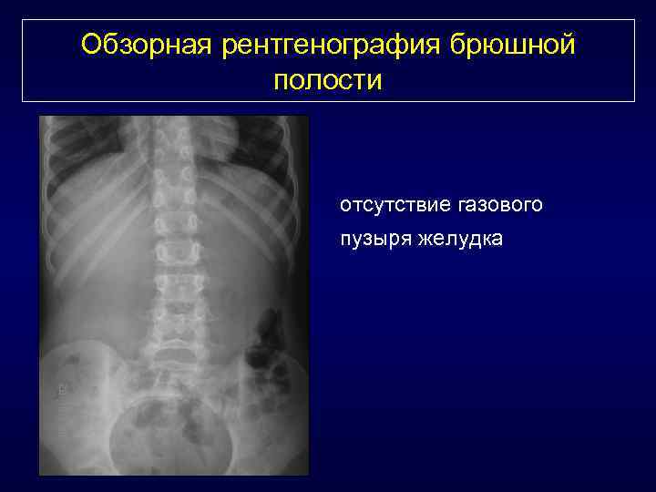 Обзорная рентгенография брюшной полости отсутствие газового пузыря желудка 