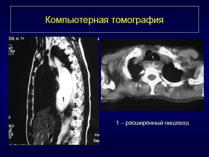 Компьютерная томография 1 – расширенный пищевод 