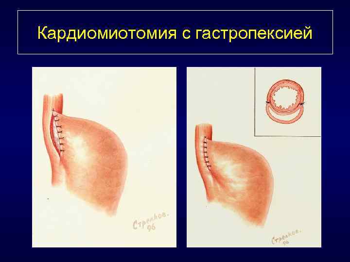 Кардиомиотомия с гастропексией 