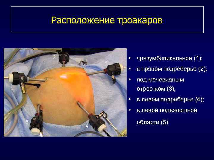 Расположение троакаров • чрезумбиликальное (1); • в правом подреберье (2); • под мечевидным отростком