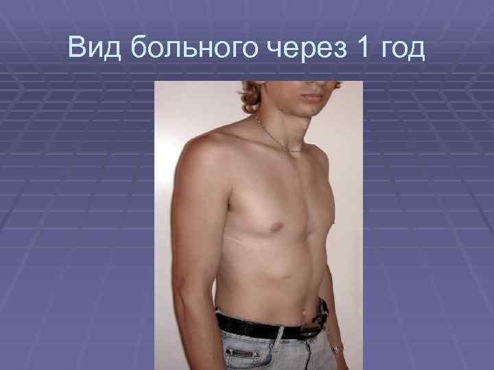 Вид больного через 1 год 
