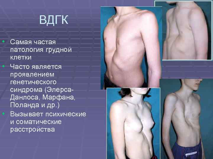 ВДГК • Самая частая патология грудной клетки • Часто является проявлением генетического синдрома (Элерса.