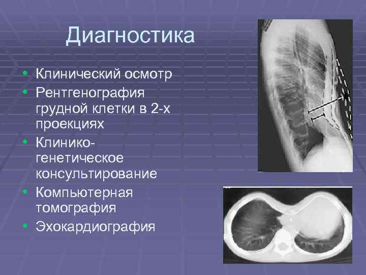 Диагностика • Клинический осмотр • Рентгенография • • • грудной клетки в 2 -х